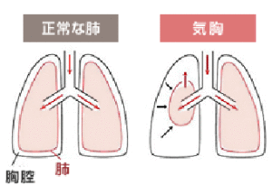 気胸とは?女性と男性の原因の違いについて。